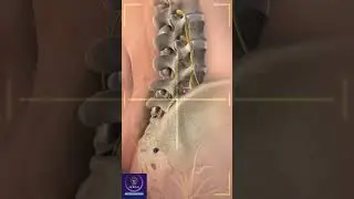Spine Surgery Herniated disk, CT Scan 