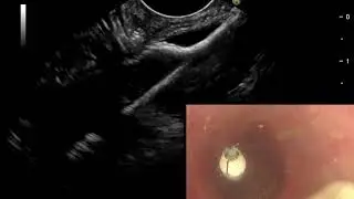 EUS-Guided Colo-colostomy for the Treatment of Benign Complete Occlusion of Colonic Anastomosis
