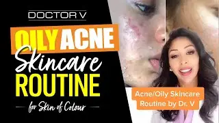 Doctor V - Oily, Acne Skincare Routine For Skin of Colour | Brown Or Black Skin | 