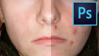Photoshop Tutorial - How to Remove Acne/Pimples Using Photoshop