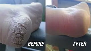 Fixing my severely cracked feet at home in one week