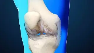 Osteoartritis
