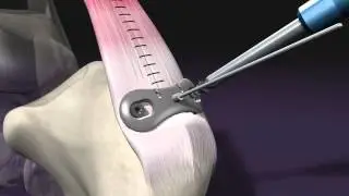 BioPro - Virtual Haglunds Procedure