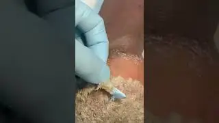 Trauma Effects On The Feet