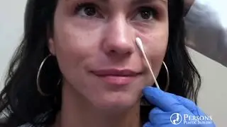 Before and After Filler