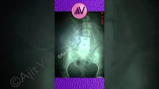 Breech with Footling X-ray