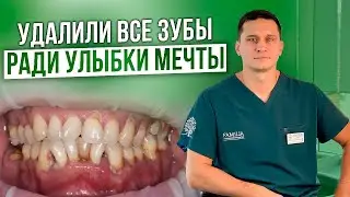 Удаление 27 зубов одномоментно! / История Улыбки