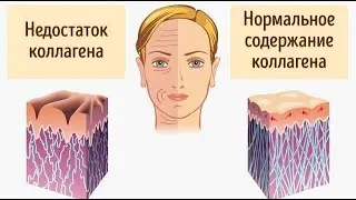 Последствиях дефицита коллагена