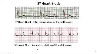atrio-ventricular nodal (AVN) blocks for exercise professionals: part 1: what are they; case study 1