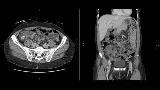 Abdominal Imaging Call Prep Cases: Acute Uncomplicated Appendicitis (CT) Case 1 Discussion