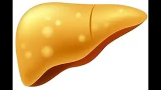 AFLP (Acute Fatty Liver of Pregnancy)_Dr Pradeep Rangappa