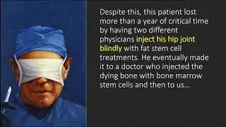 Hip AVN Osteonecrosis Stem Cell Scam