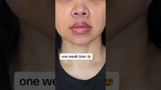 Lip Lift Surgery Results 