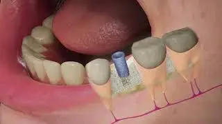 Root canal treatment - 3D Animation