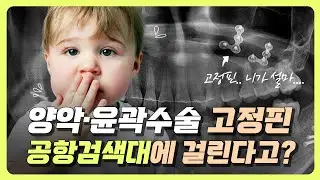 양약 윤곽 수술 고정핀, 공항 검색대에서 알람이 울린다고? 뉴스 기사에 나옴 😱 #양악수술 #안면윤곽수술 #고정핀 #공항검색대