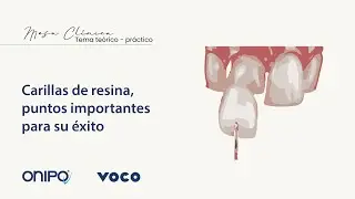 Carillas de resina, puntos importantes para su éxito