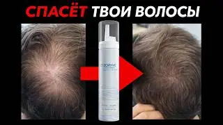 New Hair Loss Treatment in 2026: Roflumilast, Inflammation, and DHT