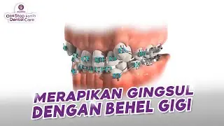 CARA MERAPIKAN GIGI GINGSUL DENGAN BEHEL GIGI