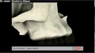 Implants - Bone Atrophy Upper Maxilla - Dentist Ottawa