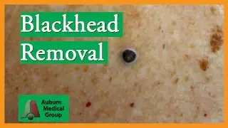 Large Blackhead Removal without Extractor Tool | Auburn Medical Group