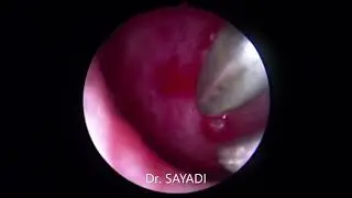 Angiome de la cloison nasale                                       Angioma of the nasal septum