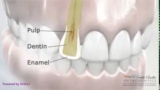 Interproximal Reduction Showing Cross Section - Orthodontic Treatment