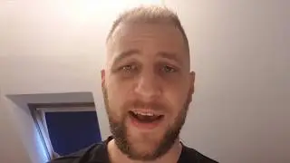 Hair Transplant Turkey Before After Result 10 Weeks