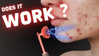 Do High Frequency ACNE WANDS actually WORK?