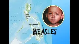 Philippines report 5x increase in measles in 2024