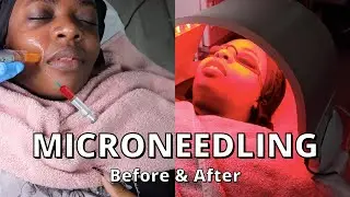 microneedling for dark spots, before and after | microneedling and led light therapy