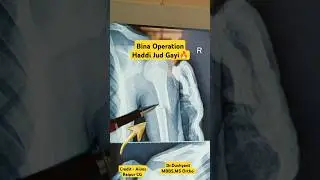 बाजू की हड्डी सर्जरी बिना भी जुड़ गई 🔥#humerus #fracture