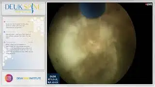 Laser Spine Surgery for Discogenic Lower Back Pain from Herniated Disc L2-L5