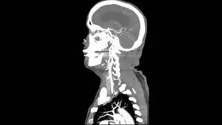 hydrocephalus