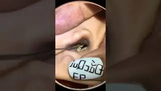 Amazing Ear Waxing