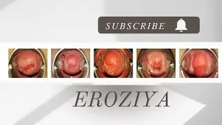 Erroziya - Bachadon bo’yni raki