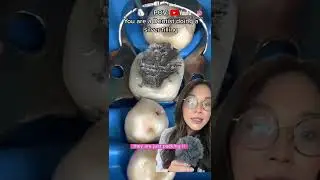 Dentist does a silver filling. 