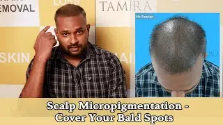 SCALP MICROPIGMENTATION - Cover Your Bald Spots(BEFORE AND AFTER )at Tamira in Chennai