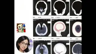 Ataques a imágenes médicas: Exploring adversarial attacks in federated learning for medical imaging