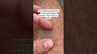Doctor Teaches: HOW TO REMOVE A TICK