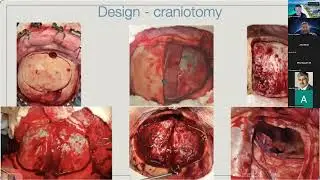 Meningioma Surgery – Professor Byron Salazar