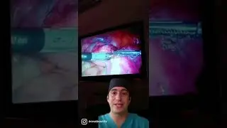 Laparoscopic Hysterectomy: How is it done? A brief description.