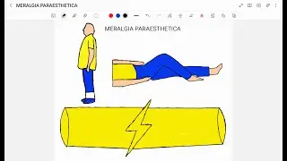 MERALGIA PARAESTHETICA