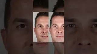 Halo Laser Treatment | Dr. Paul Nassif
