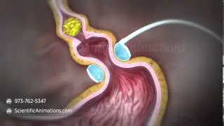 Gastric Band Animation | Digestive System Animation