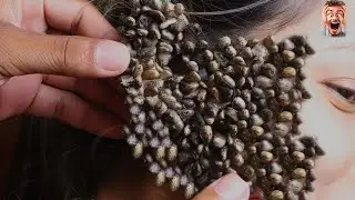 Oh god ! Look How to Remove Giant Ticks on on my