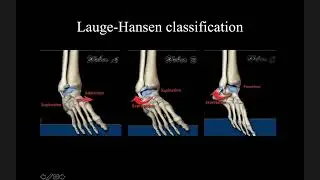 Tiếp cận chẩn đoán hình ảnh chấn thương cổ chân, bàn chân - BS. Nguyễn Duy Hùng