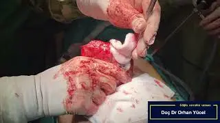 AKCİĞER KANSER AMELİYATI. SEÇİLMİŞ HASTALARDA TAM ŞİFA