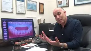 כמה שתלים צריך כדי להשלים לסת אחת?