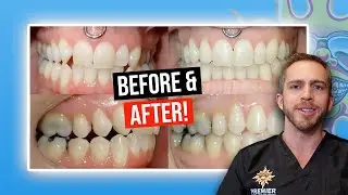 Missing Lateral Incisors w/ Braces?! (BEFORE & AFTER)
