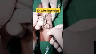 Metallic K- Wire Insertion Bone 🔥 तार से हड्डी Fix करना |